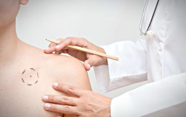 Висячие родинки: в чем опасность, когда удалять?