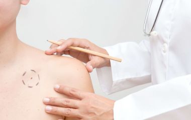 Иссечение опухоли кожи: что важно знать перед процедурой