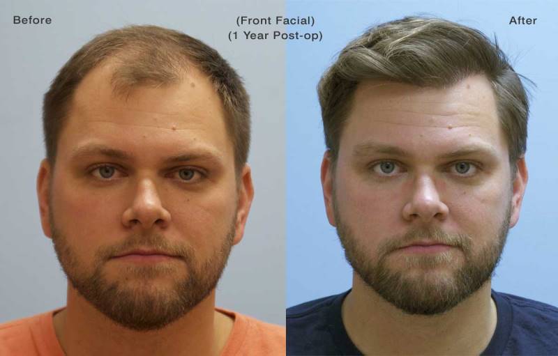 Фото до и после пересадки волос 