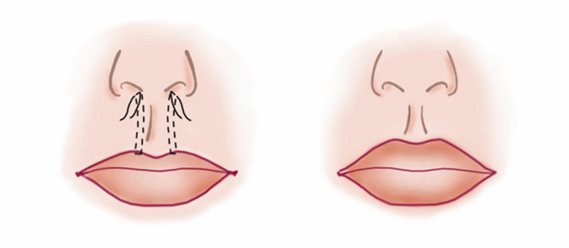 схема операции пластики губ