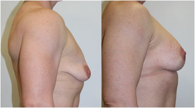 Фото до и после подтяжки грудных желез 