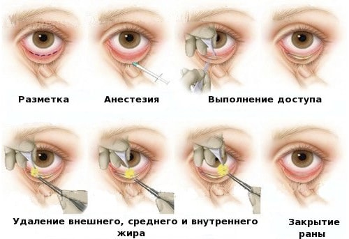 схема блефаропластики нижнего века