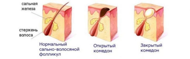 схема видов комедонов на лице 