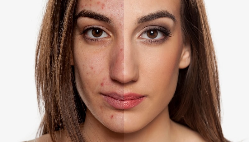 Проблемная кожа лица: до и после 