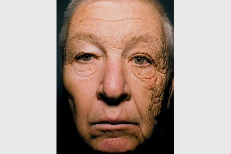 Фотостарение кожи на примере мужчины 